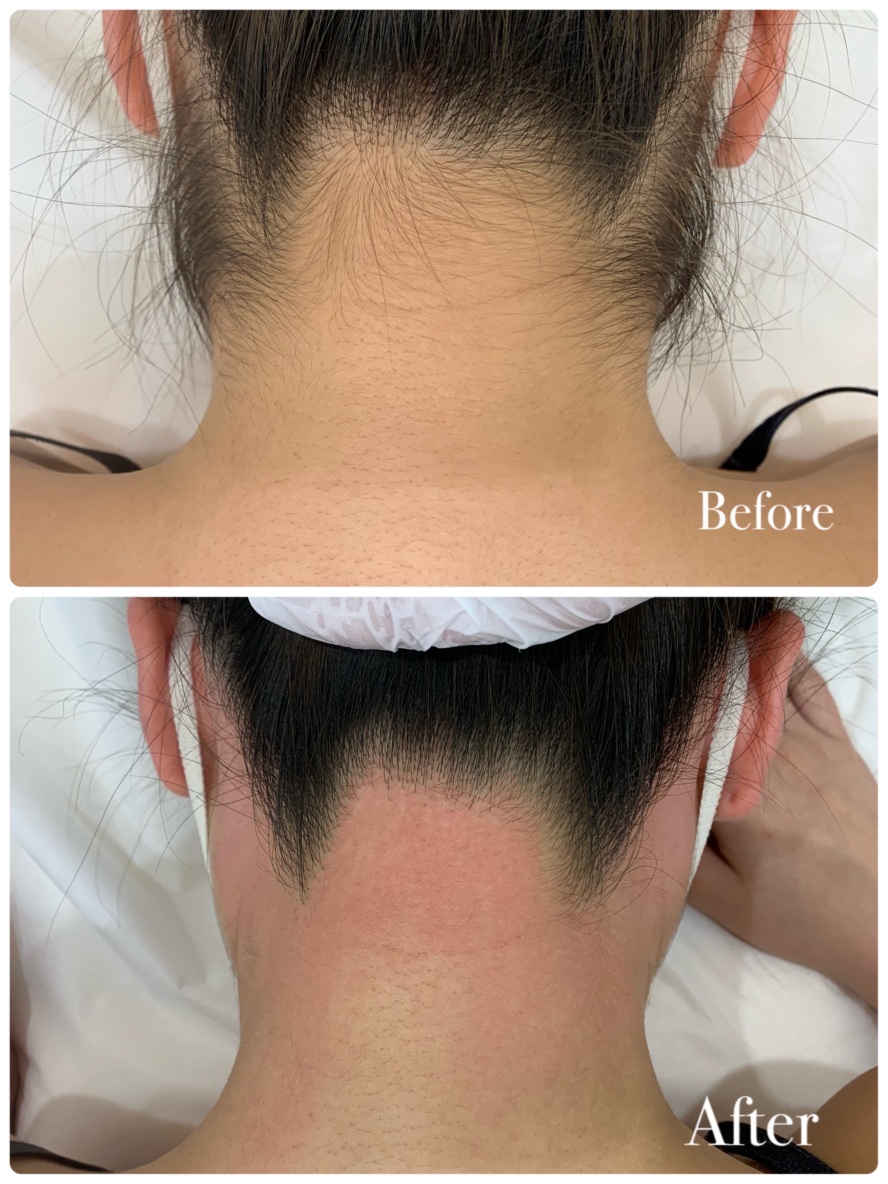 うなじが気になる方におすすめクーポン♪